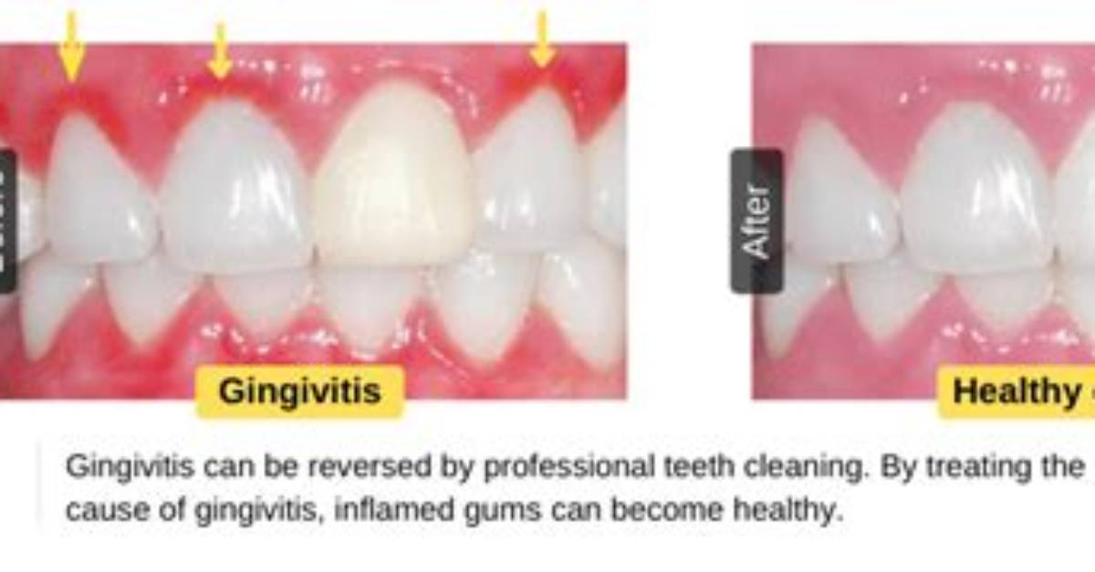 Can Gingivitis Damage Be Reversed?