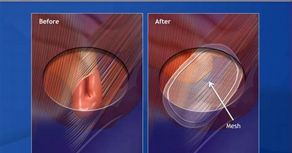 Can Hernia Mesh Move?