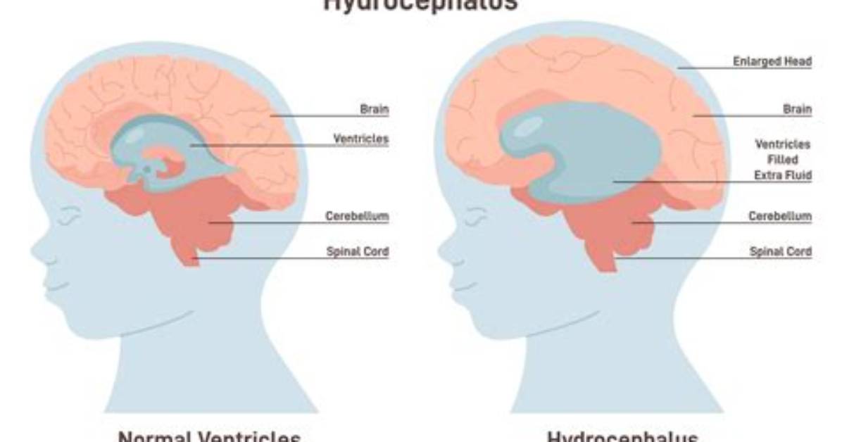 Can Hydrocephalus Be Cured?