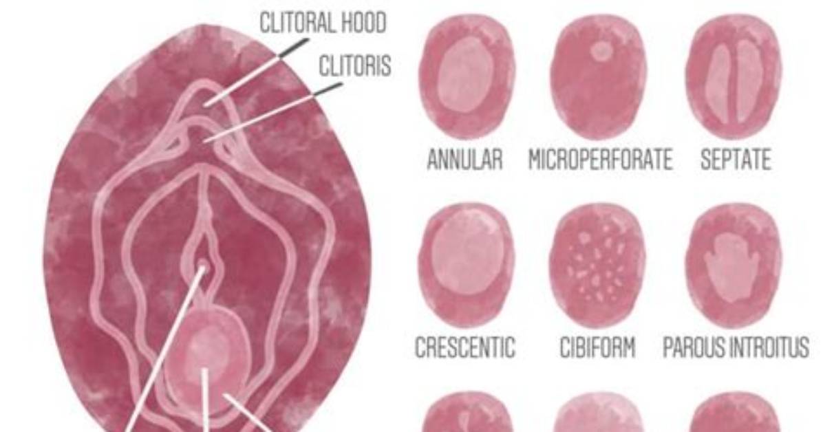 Can Hymen Break Partially?