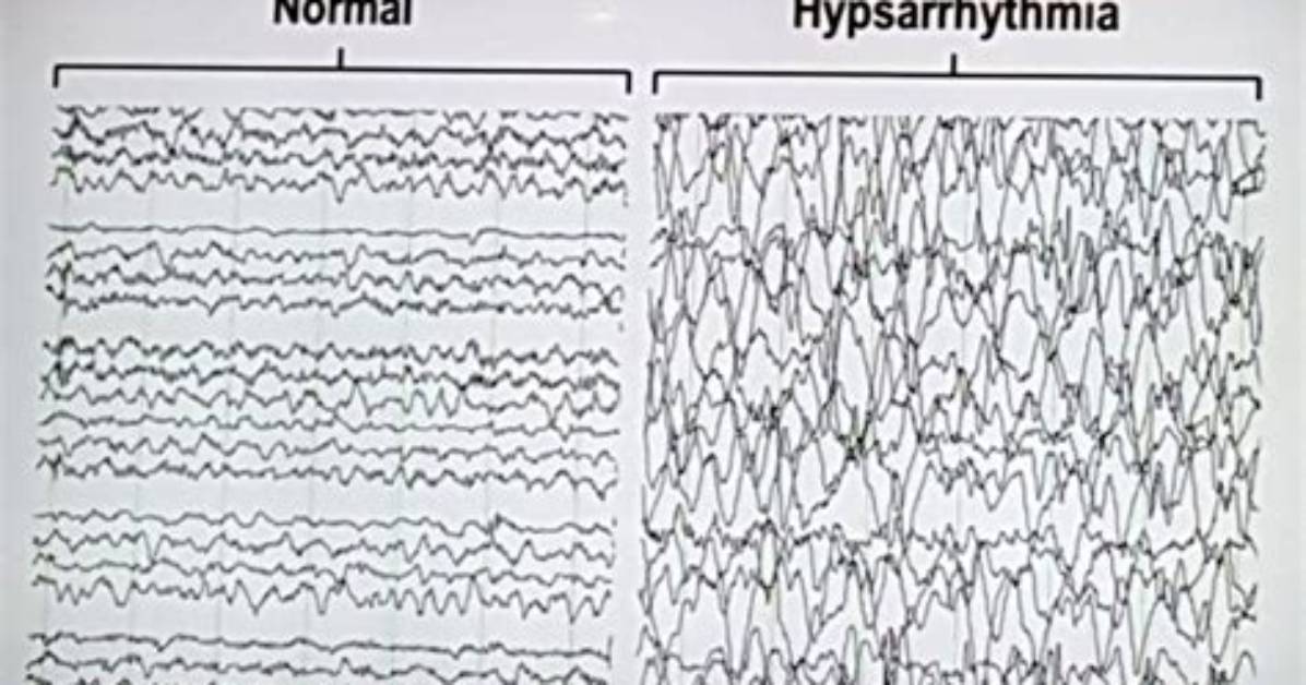 Can Hypsarrhythmia Come Back?