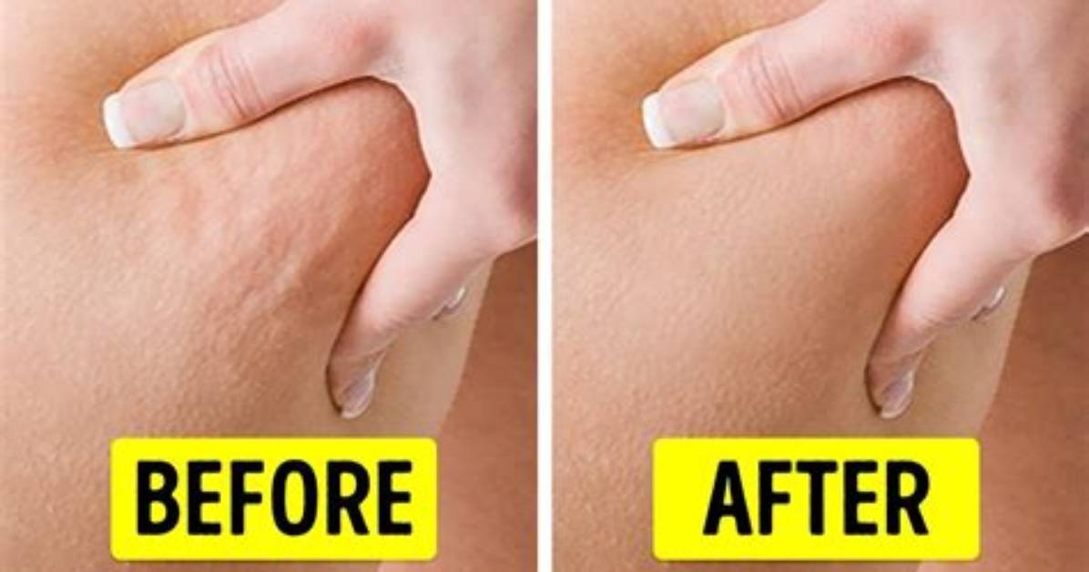Can I Improve Cellulite in 2 Weeks?