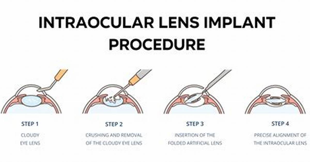 Can Implanted Lenses Be Removed?