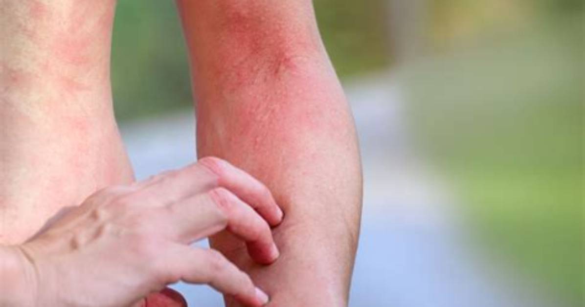 Can Insulin Cause Rashes