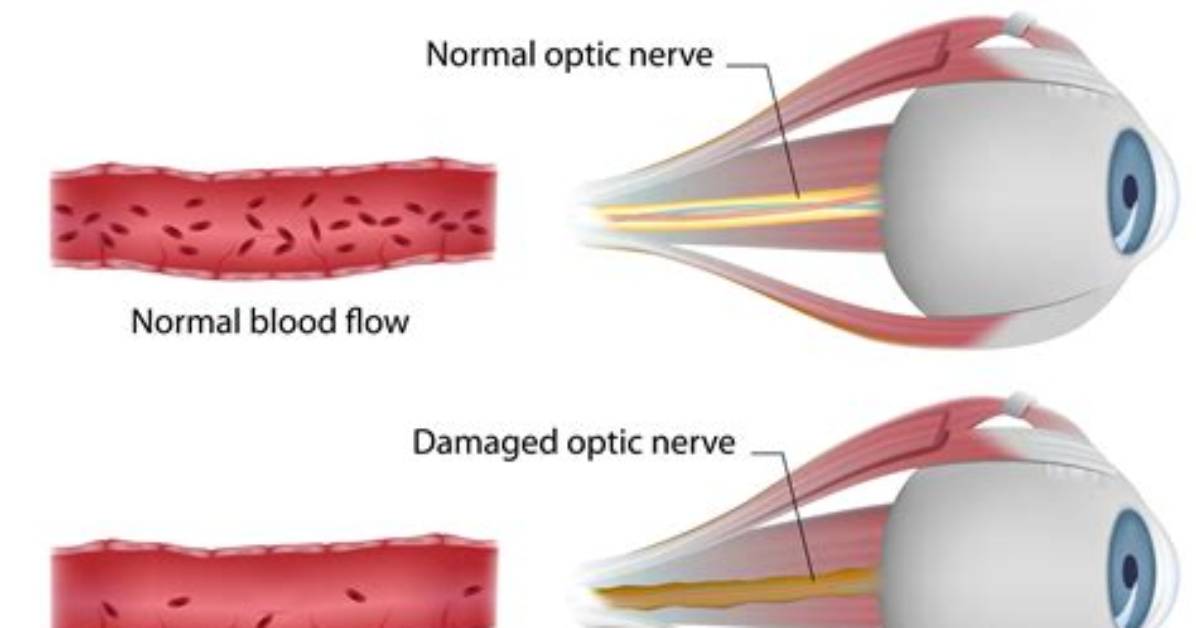 Can Ischemic Optic Neuropathy Be Reversed?