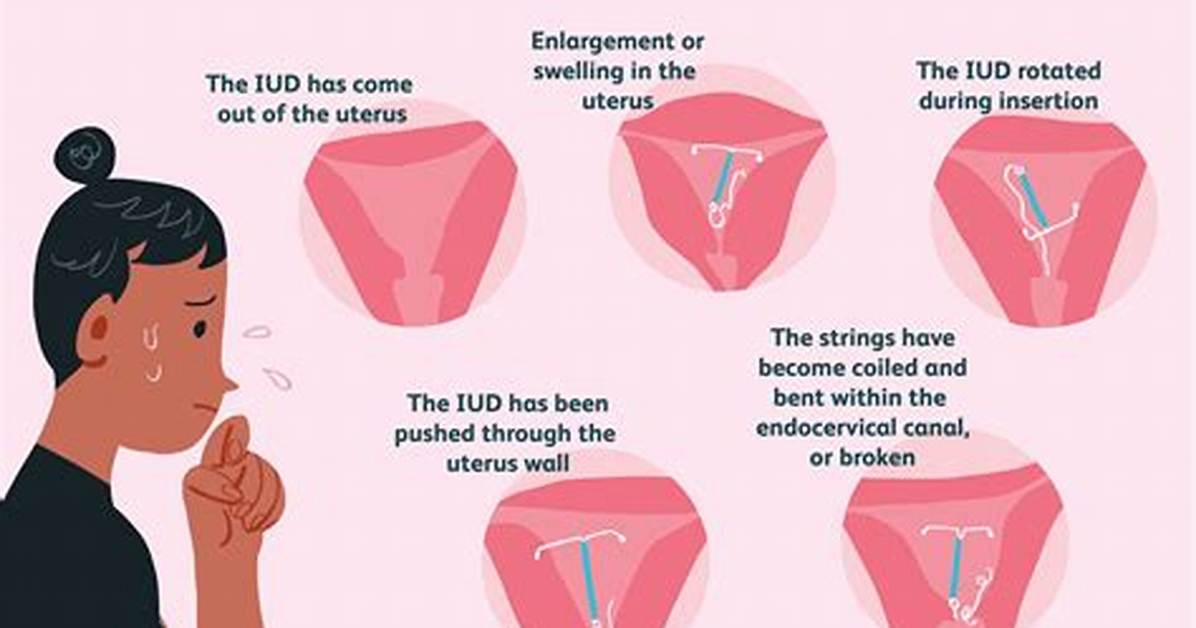 Can Iud Be Dislodged During Intercourse?