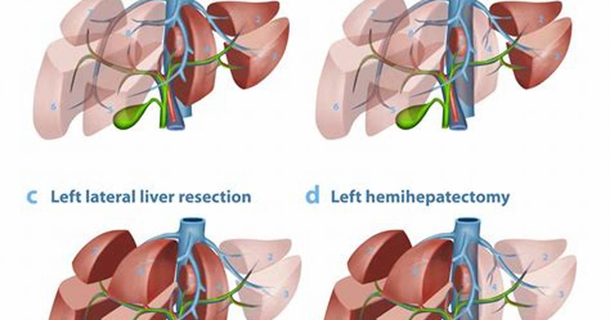 Can Liver Resection Be Done Laparoscopically?