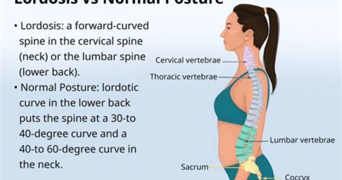 Can Lordosis Be Corrected?