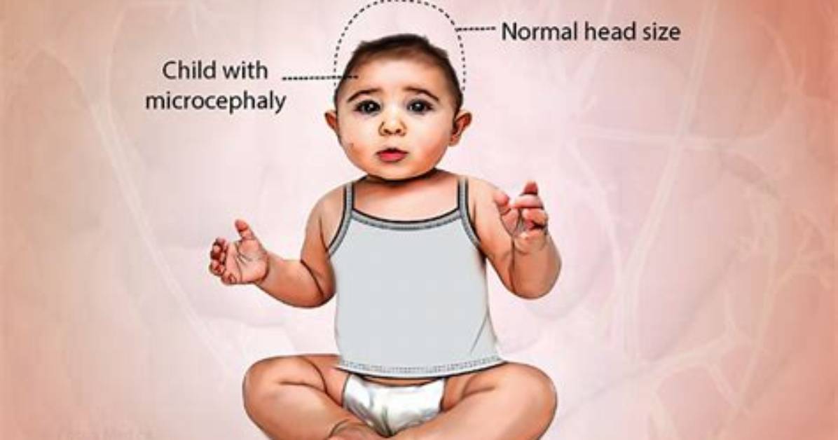 Can Microcephaly Be Genetic?