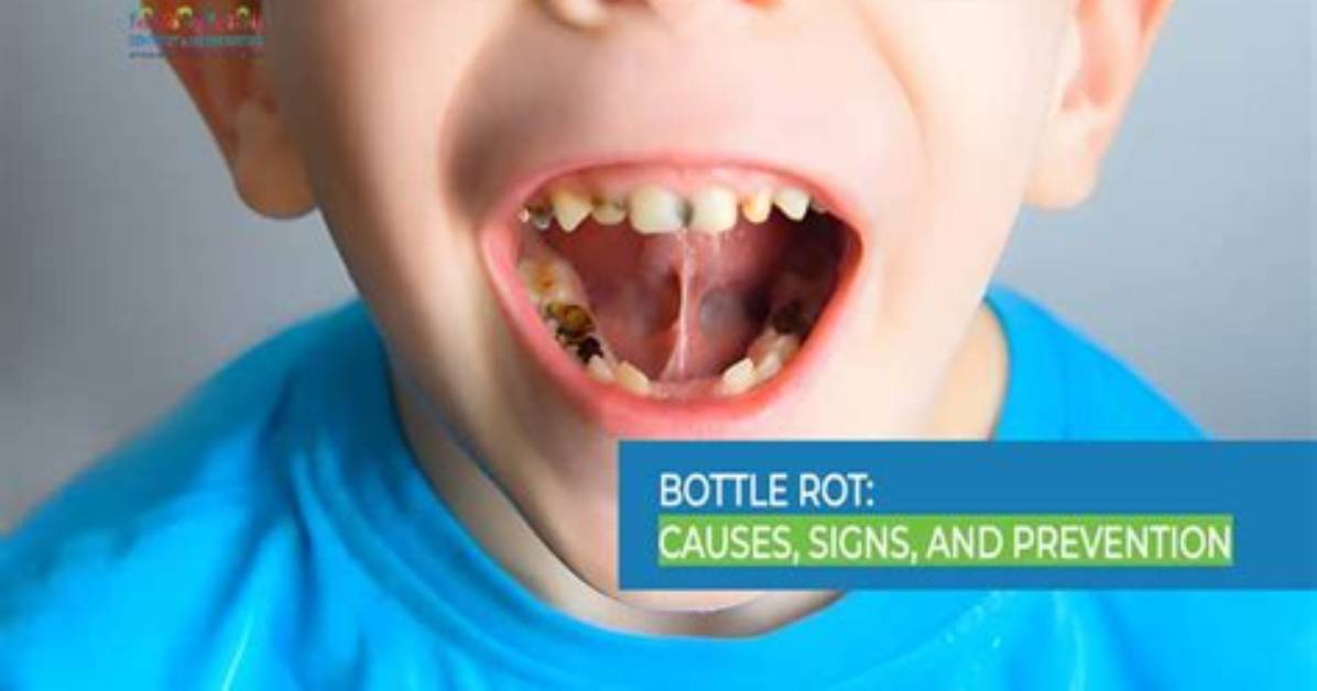 Can Milk Rot Teeth?