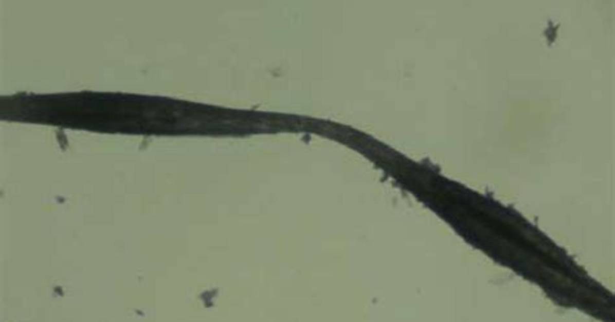 Can Monilethrix Be Prevented?