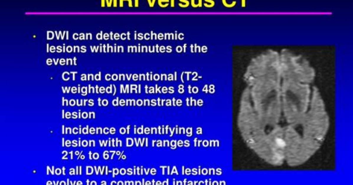 Can Mri Detect Transient Ischemic Attack?
