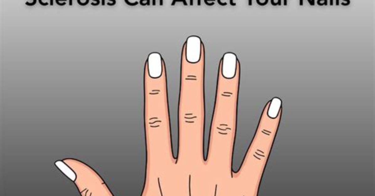 Can Ms Affect Nails?