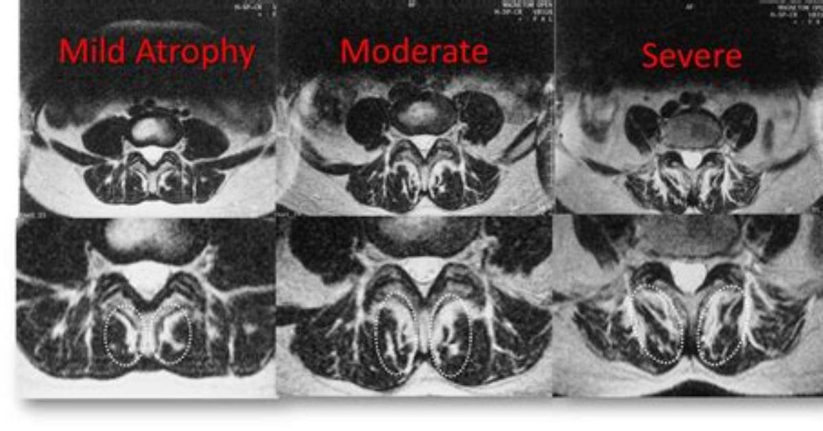 Can Multifidus Atrophy Be Reversed?