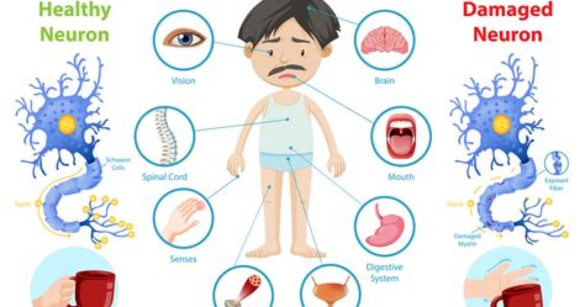Can Multiple Sclerosis Kill You?