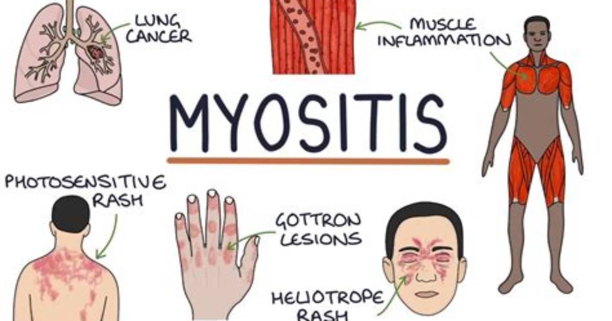 Can Myositis Be Prevented?