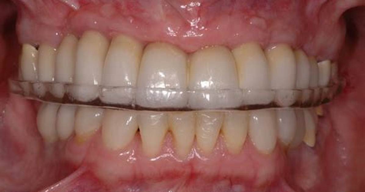 Can Occlusal Splint Move Teeth?