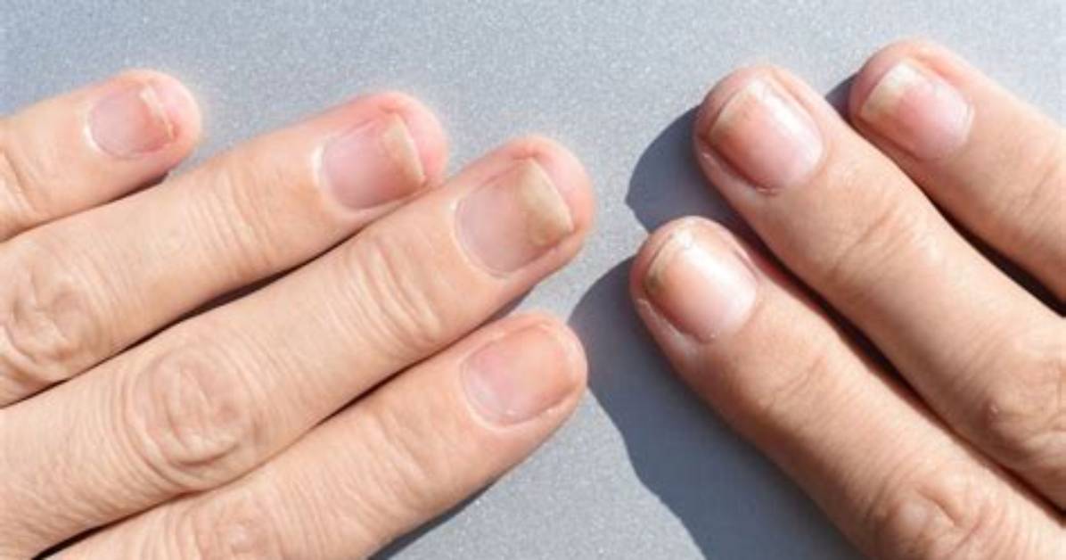 Can Onycholysis Be Treated