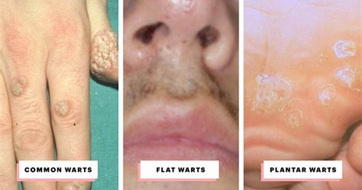 Can Pimples Look Like Warts?