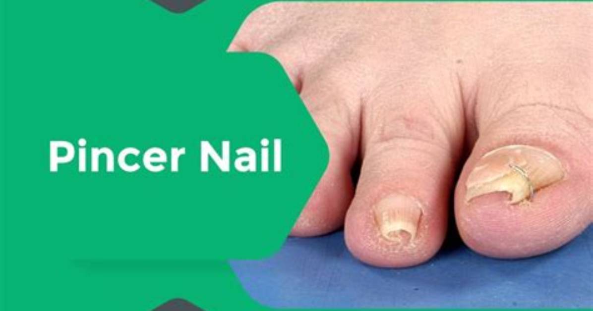Can Pincer Nails Be Corrected?