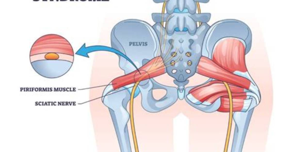 Can Piriformis Cause Permanent Damage?