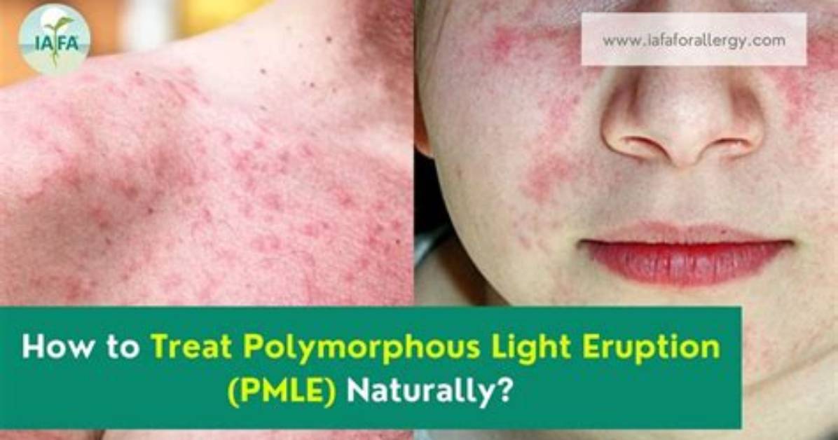 Can Polymorphous Light Eruption Be Cured?