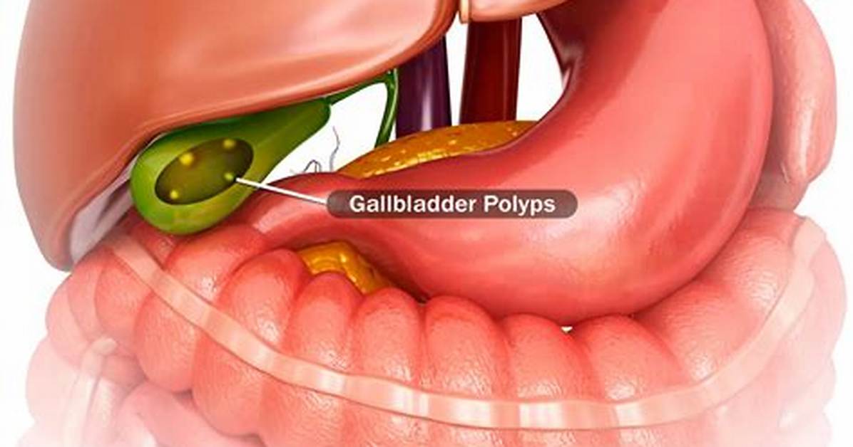 Can Polyps Cause Diarrhea?
