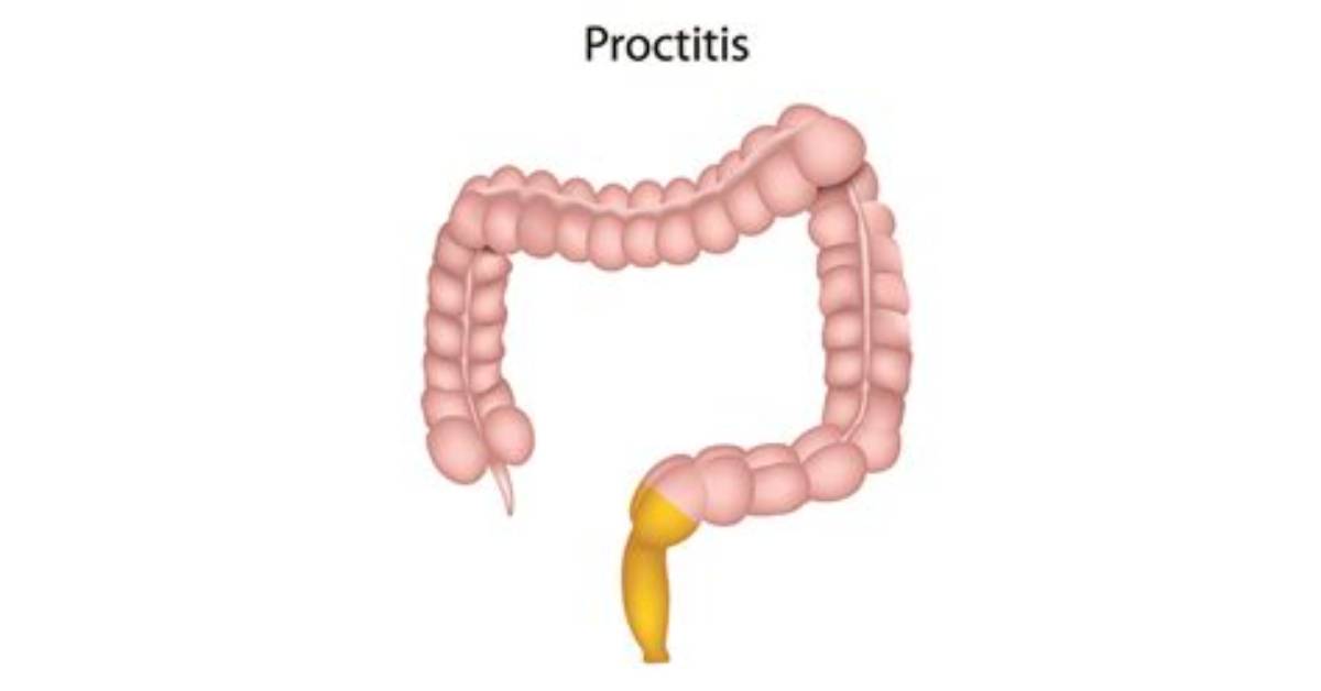 Can Proctitis Be Cured? | Contextresponse. Com