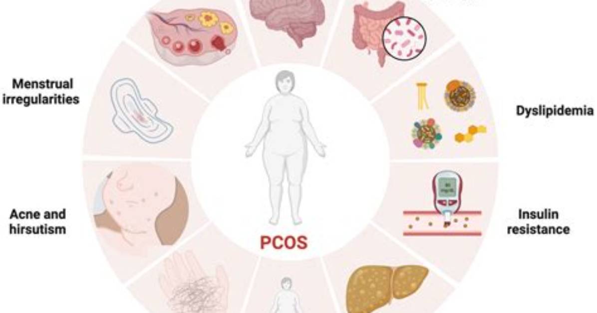 Can Puberty Cause Pcos