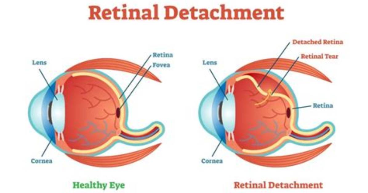 Can Retinal Detachment Be Fixed?