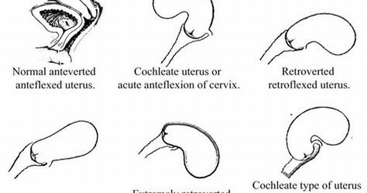 Can Retroverted Uterus Be Corrected?