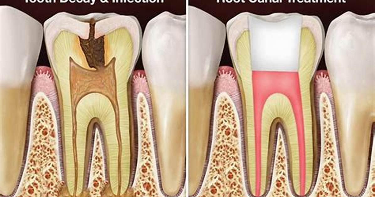Can Root Canals Kill You?