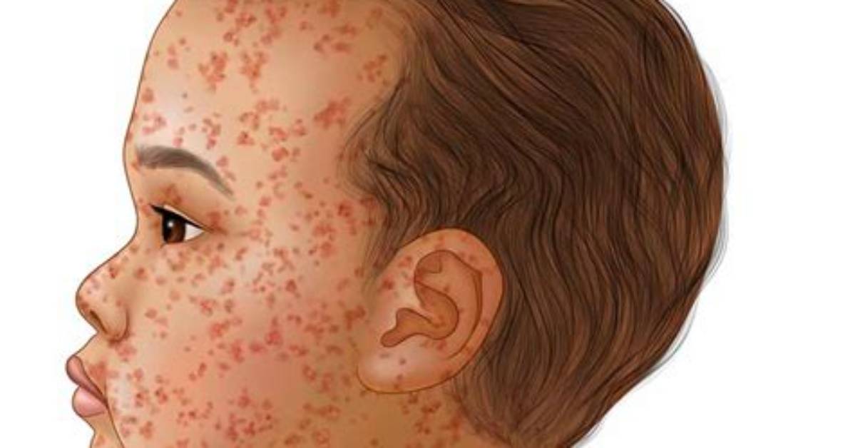 Can Rubella Kill You?