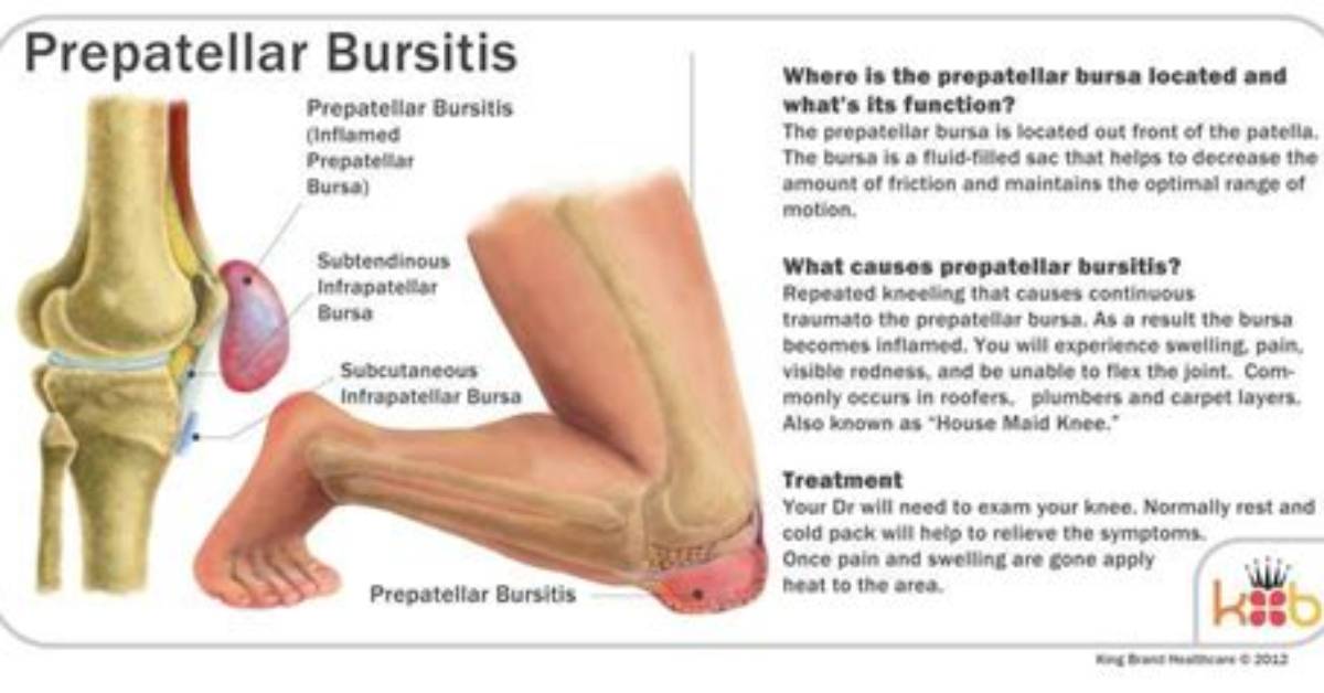 Can Running Cause Prepatellar Bursitis?