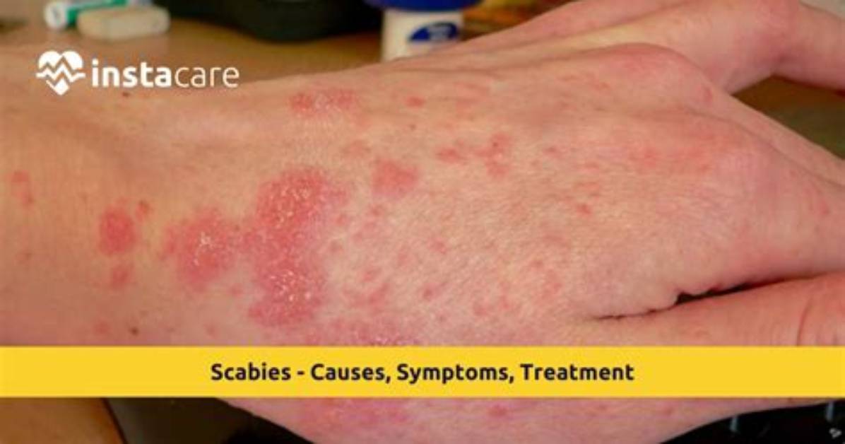 Can Scabies Be Cured?