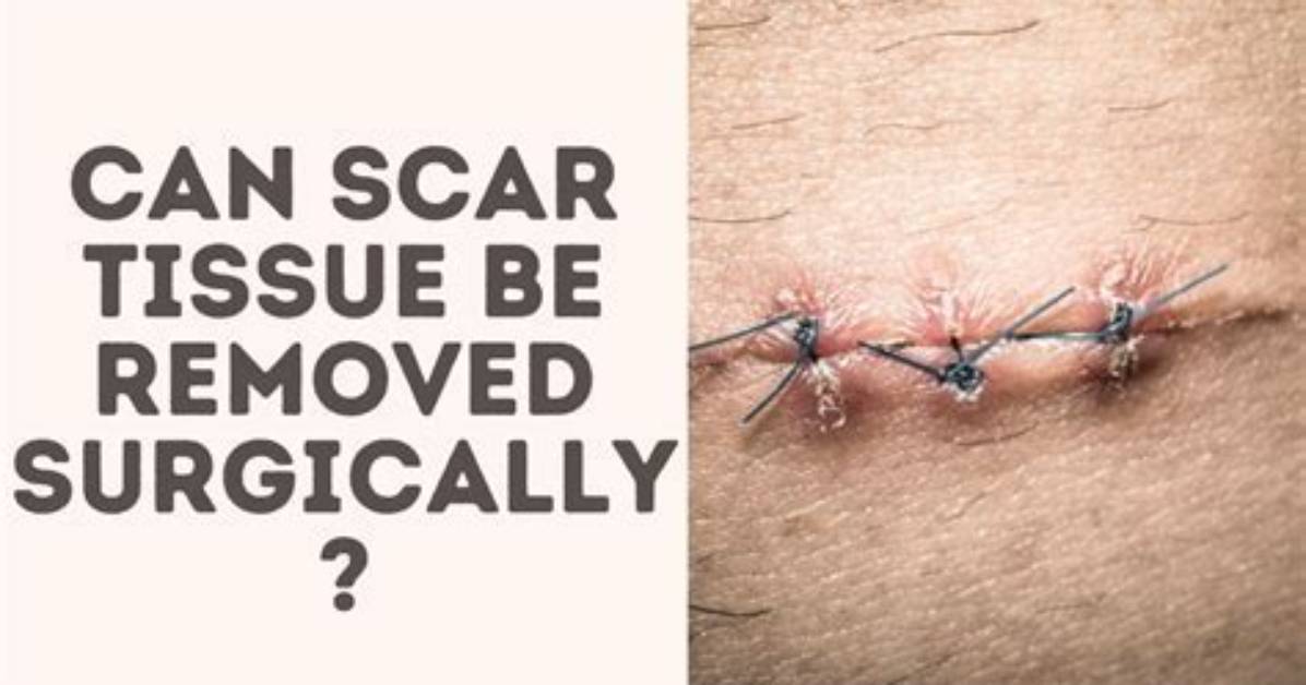 Can Scar Tissue Be Removed?