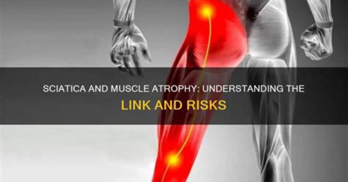 Can Sciatica Cause Muscle Atrophy
