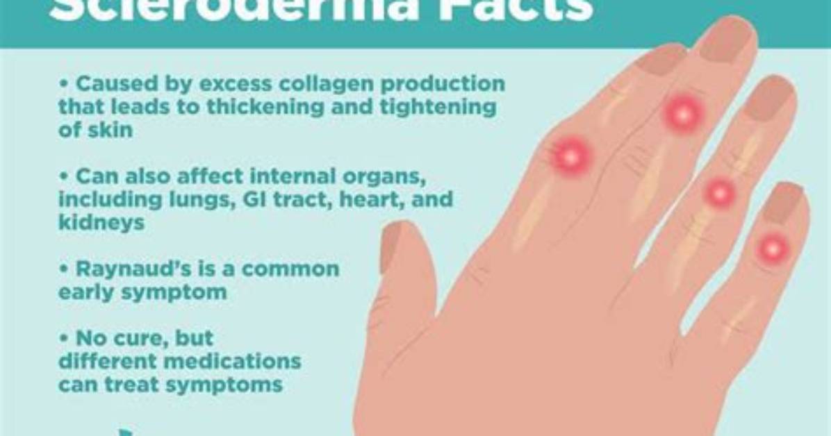 Can Scleroderma Kill You?