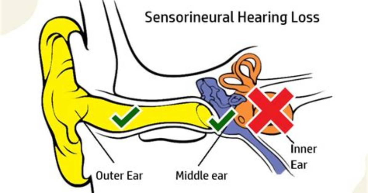Can Sensorineural Hearing Loss Be Corrected