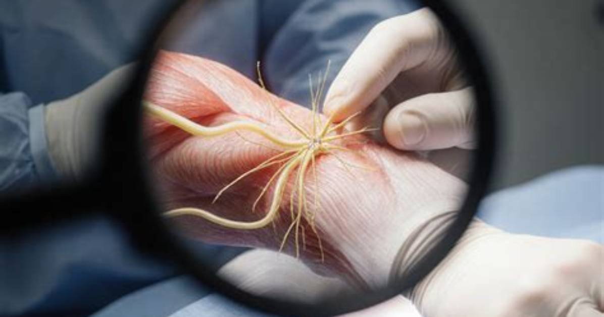Can Severed Nerves Be Repaired?