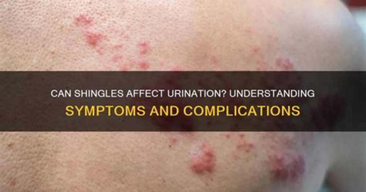 Can Shingles Affect Your Urine?