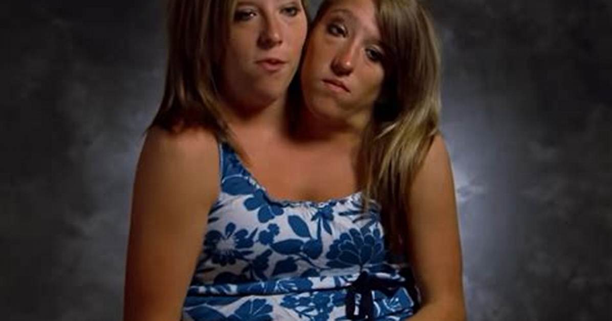 Can Siamese Twins Be Separated?