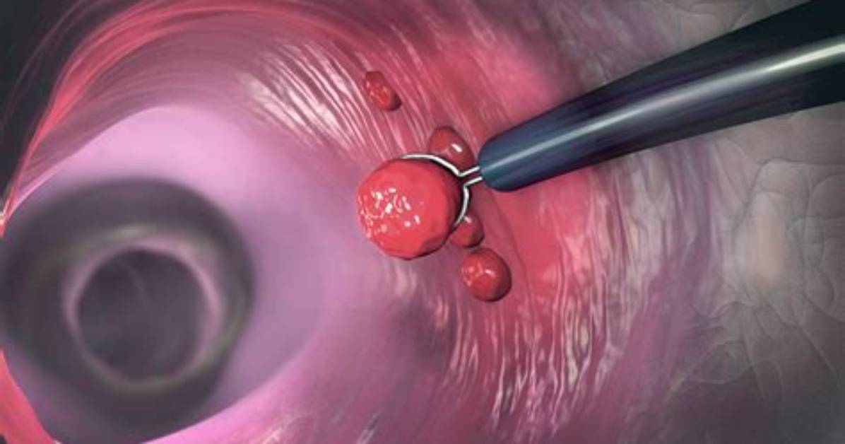 Can Sigmoidoscopy Remove Polyps?