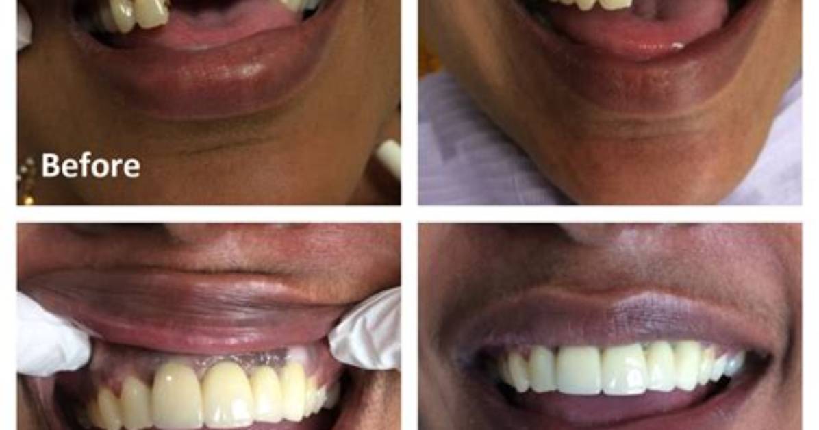 Can Single Teeth Be Implanted?
