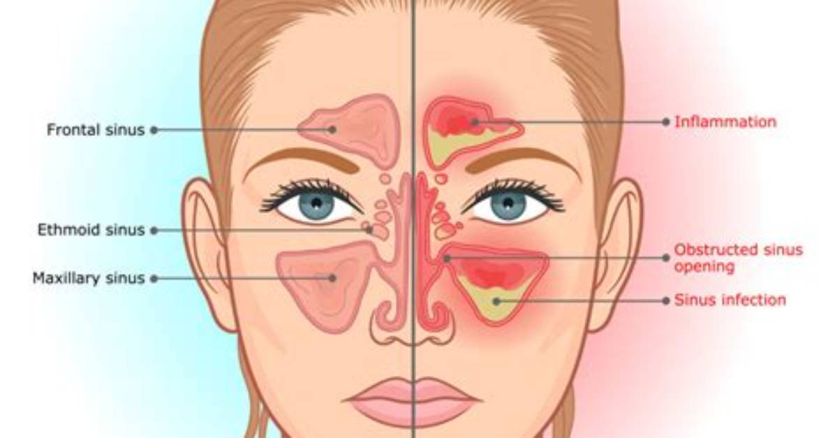 Can Sinuses Make Your Face Ache?