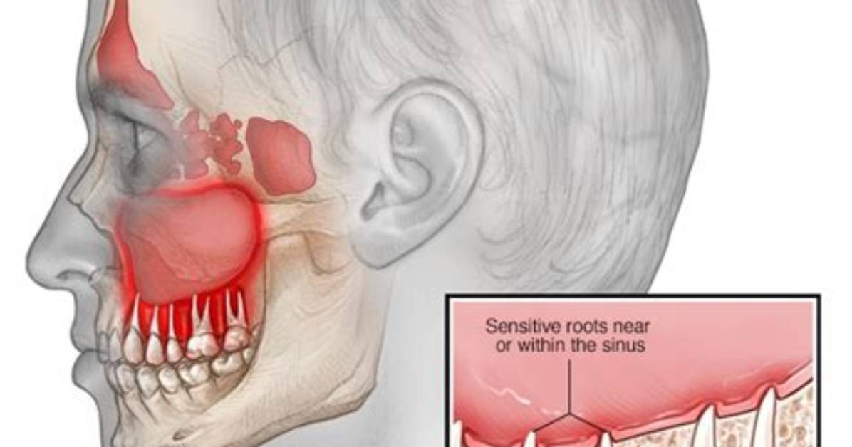 Can Sinusitis Cause Gum Abscess
