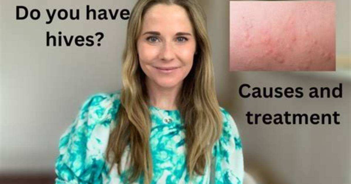 Can Soap Cause Hives