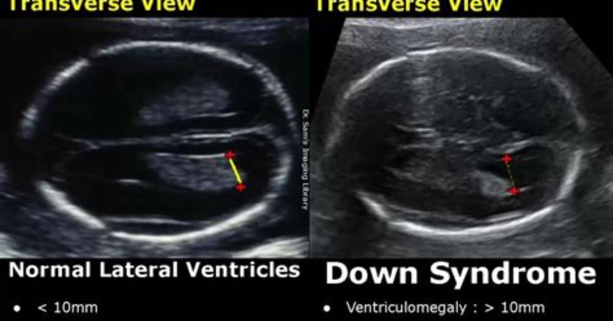 Can Sonogram Detect Down Syndrome?