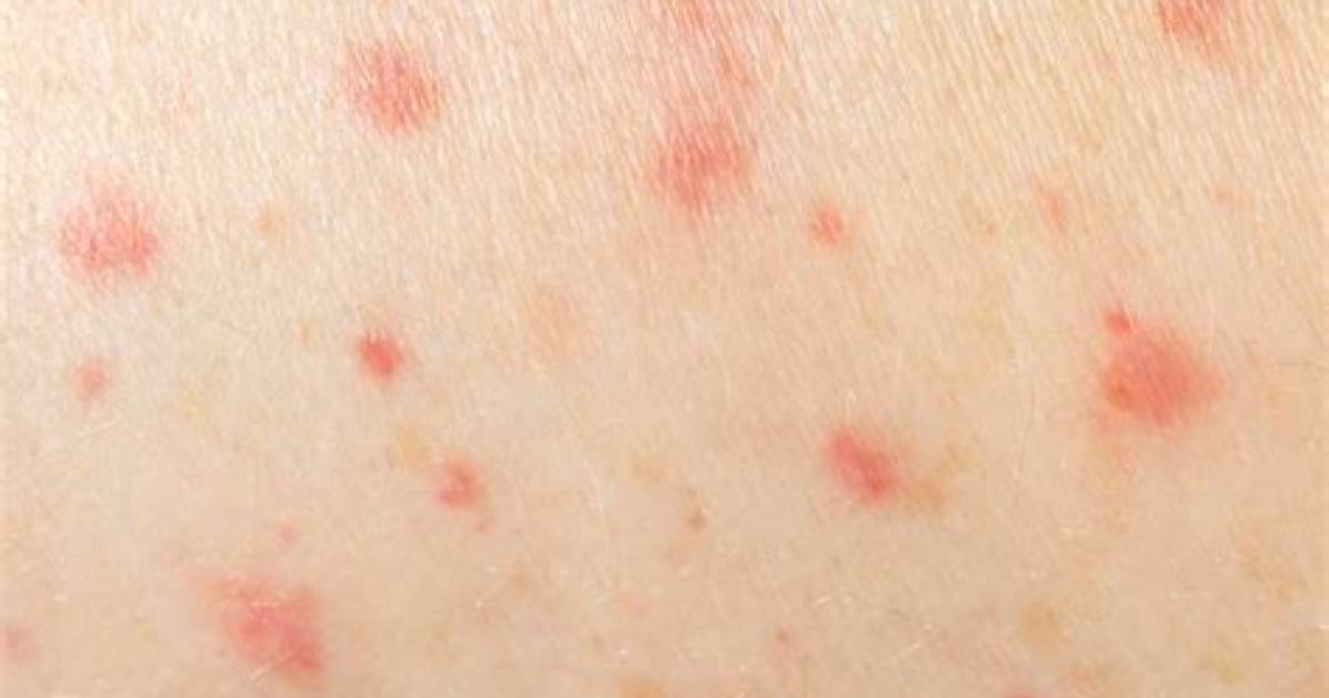 Can Sperm Cause Itching?