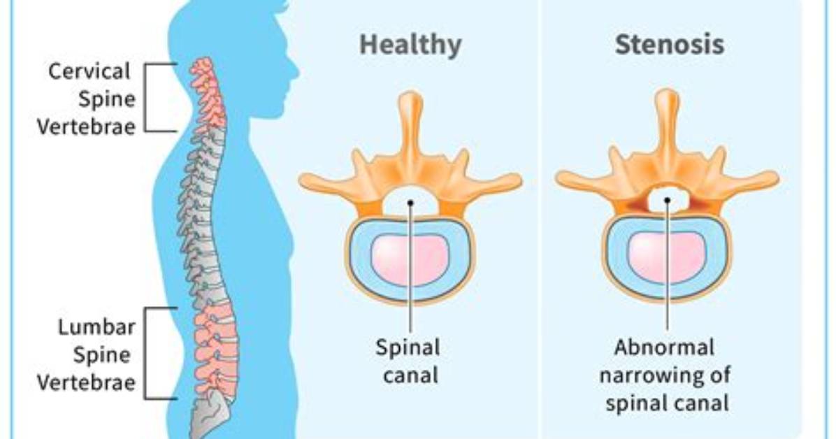 Can Spinal Stenosis Cause Paralysis?